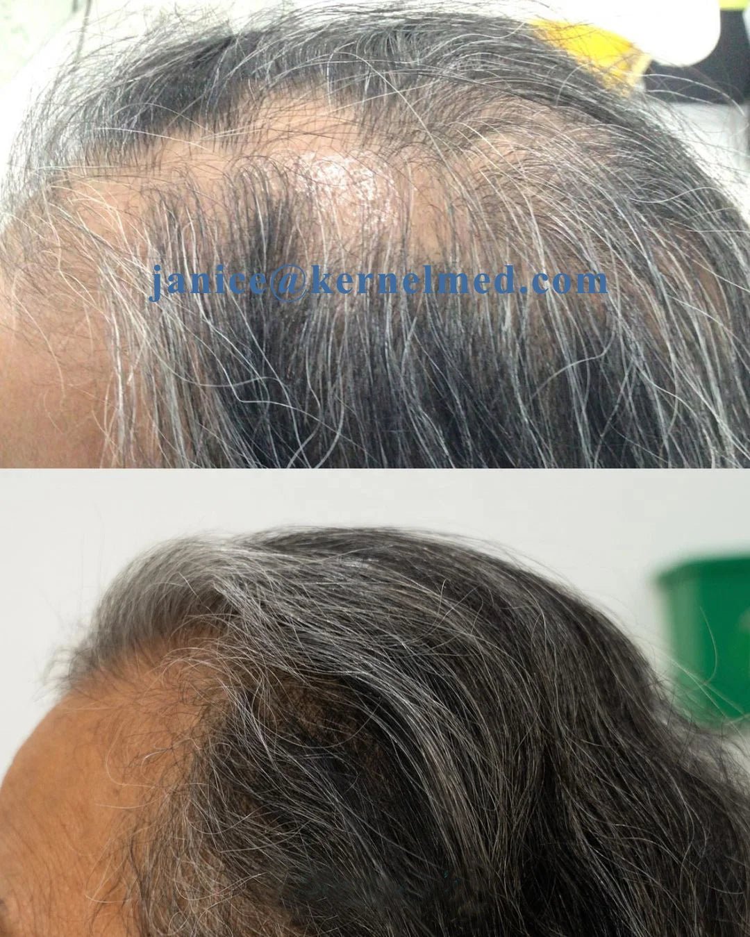 KN-8000B Hair Regrowth Helmet — Clinically Tested Technology - Matos